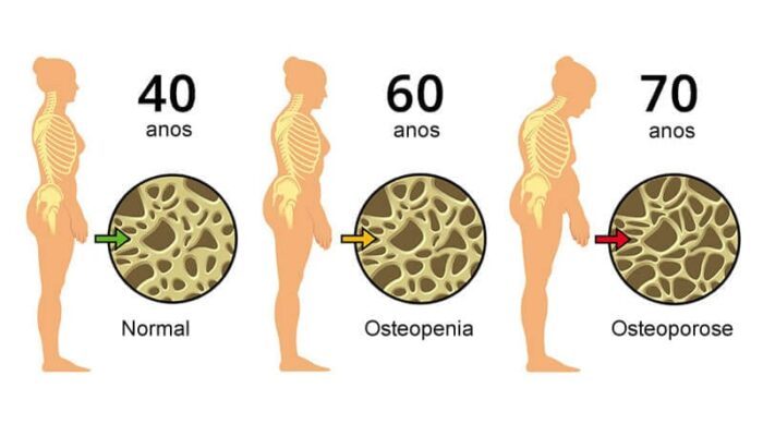 Tratamento para osteoporose começa por uma boa alimentação