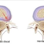 protusao discal
