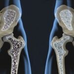 Descubra quais são as causas e os sintomas da osteoporose