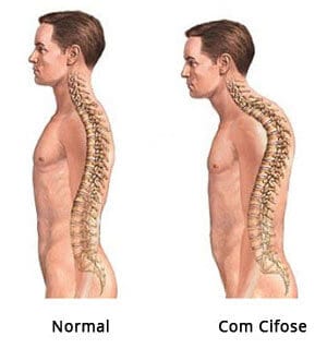 Qual a diferença entre escoliose e má postura?