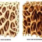 Você sabe o que é osteoporose e quais são os sintomas?