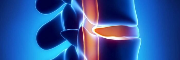hernia de disco sintomas causas tratamentos
