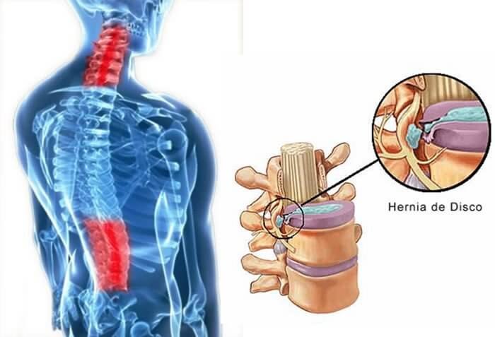 vertebrata - hernia de disco dor nas costas