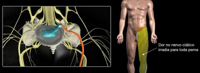 Para médico, dor no nervo ciático pode ser sintoma de hérnia de disco