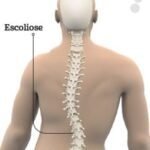 Causas e consequências da escoliose na coluna