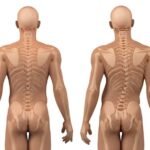 Saiba mais sobre o tratamento para escoliose