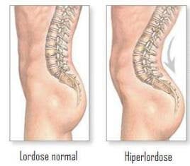 Como é feito o diagnóstico e o tratamento da hiperlordose na coluna lombar