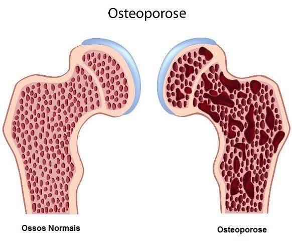 Causas e tratamento da Osteoporose