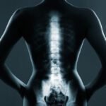 Tire suas dúvidas sobre Nucleoplastia