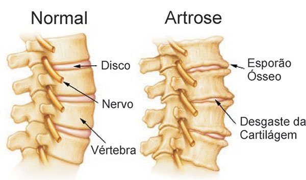 Causas e sintomas da artrose na coluna cervical e lombar