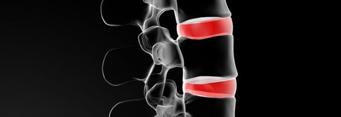 Causas e sintomas de artrose na coluna