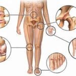 Osteoartrite atinge as articulações das mãos, coluna, joelhos e quadris