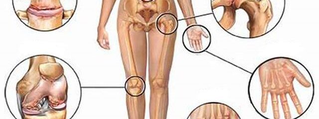 Osteoartrite atinge as articulações das mãos, coluna, joelhos e quadris