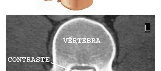 Mielografia da Coluna