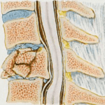 Osteoporose pode causar fratura na coluna. Saiba como prevenir!