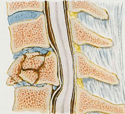 Osteoporose pode causar fratura na coluna. Saiba como prevenir!