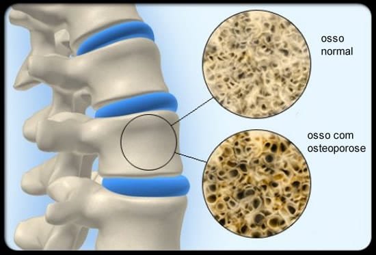 diferença entre osso com osteoporose e osso normal