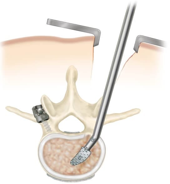 cirurgia da coluna