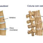 Tratamento não cirúrgico da Osteoartrite inclui repouso, perda de peso e medicamentos