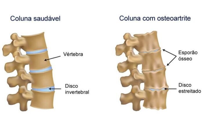 tratamento osteoartrite