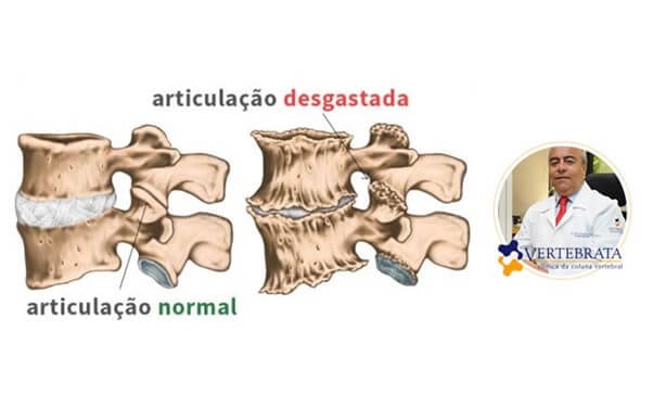artroza coloanei vertebrale
