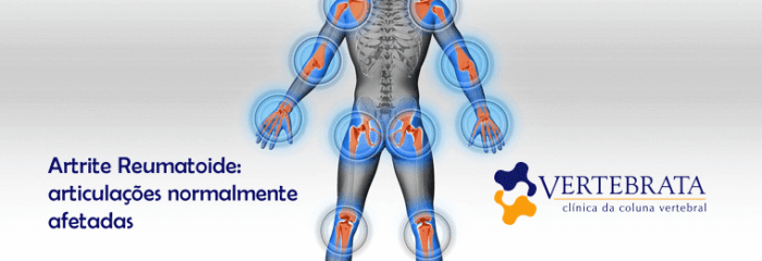 Artrite reumatoide: quais os tratamentos e como amenizar os sintomas