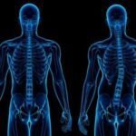 Escoliose: tratamento e cirurgia aliviam deformidade da coluna vertebral