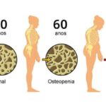 O que é e como tratar a osteopenia, condição que pode levar à osteoporose