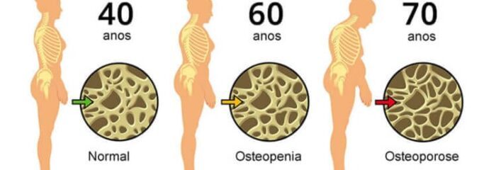 O que é e como tratar a osteopenia, condição que pode levar à osteoporose