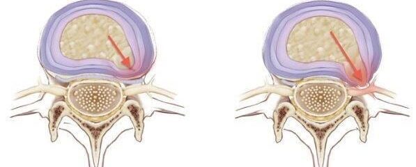 Protrusão discal pode evoluir para hérnia de disco; confira causas, sintomas e tratamentos