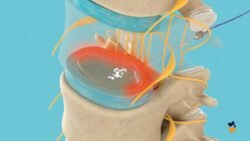 Nucleoplastia por Radiofrequência