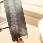 Procedimentos minimamente invasivos para coluna vertebral