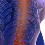 Terapia de Infusão Espinhal: 3 indicações para tratar dores na coluna