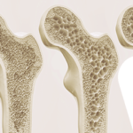 Como a cifoplastia pode restaurar fraturas na coluna vertebral