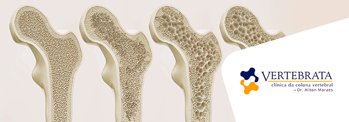 Como a cifoplastia pode restaurar fraturas na coluna vertebral