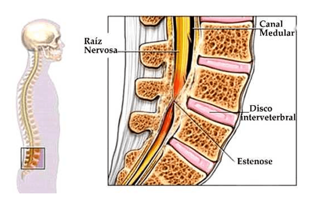 Estenose espinhal: o que é, sintomas e tratamentos
