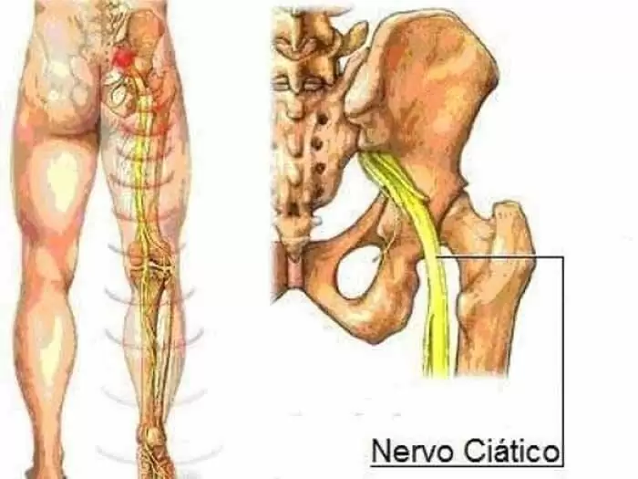 dor ciática causas sintomas tratamento nervo ciatico