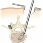 Cirurgia da coluna é indicada em casos de problemas mais graves